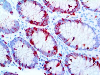Ki-67 Antibody Immunohistochemistry on an FFPE Colon Tissue